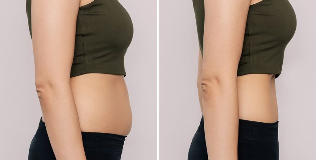 Meso Belly Fat vs. Semaglutide